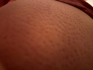 シャクティマットを使った後の背中の様子